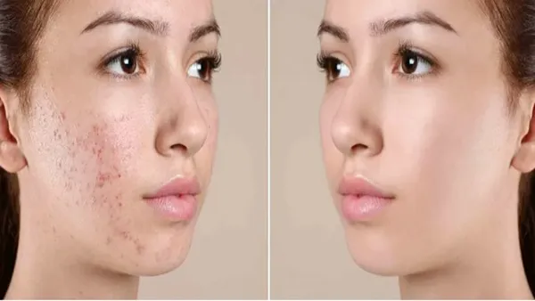 Should You See a Doctor If You Have Acne