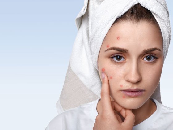 Top 5 Acne Treatments