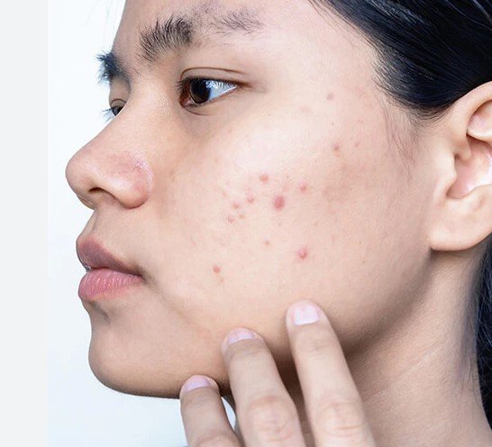 Effects of Acne